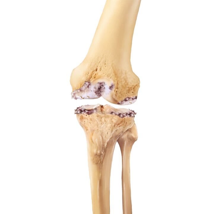 vernietiging van het kniegewricht met artrose