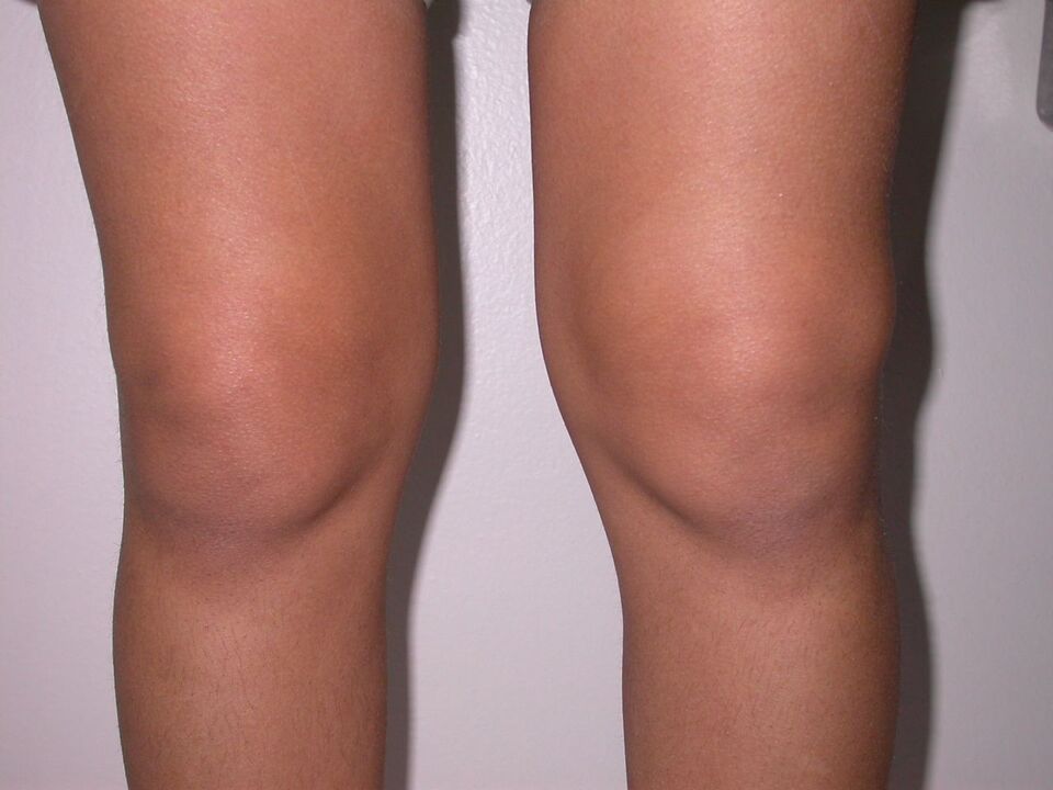 zwelling van de knie door artrose