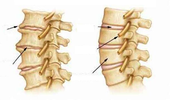 Wat is osteochondrose