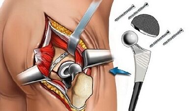 Endoprosthetics voor heupartrose