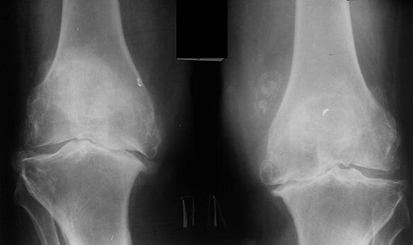 X -Ray als een manier om artrose van het kniegewricht te diagnosticeren