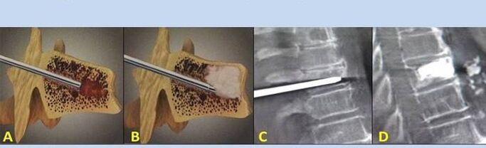 punctie vertebroplastiek voor rugpijn