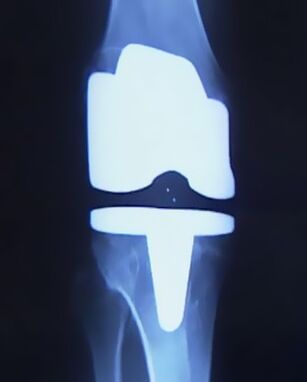 Röntgenfoto van een knie met een kunstprothese na een gewrichtsvervangende operatie