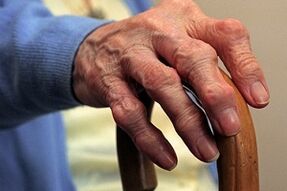 schade aan vingers met artrose