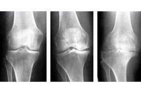 stadia van artrose van het gewricht op een röntgenfoto