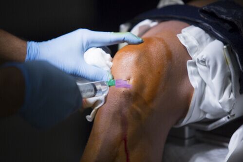 Injecties in het kniegewricht voor artrose