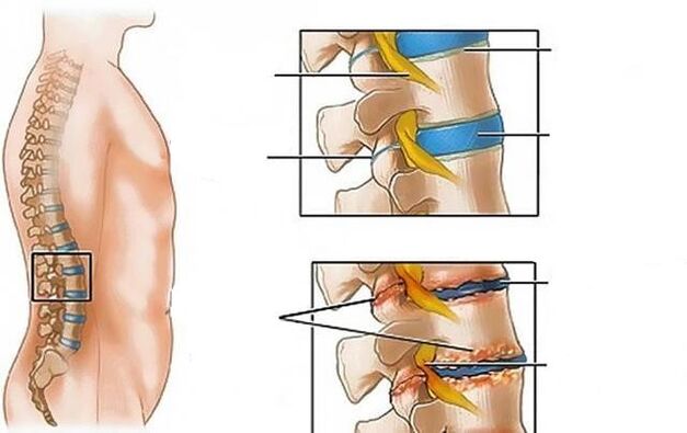 osteochondrose van de lumbale wervelkolom veroorzaakt rugpijn