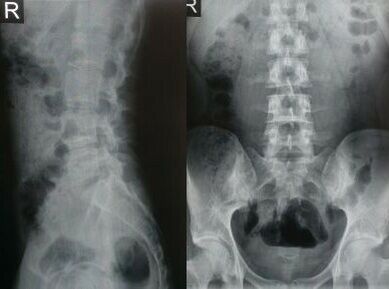 röntgenfoto van de lumbale wervelkolom
